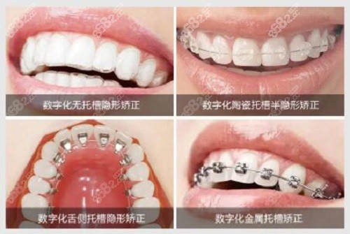 上海牙套价格