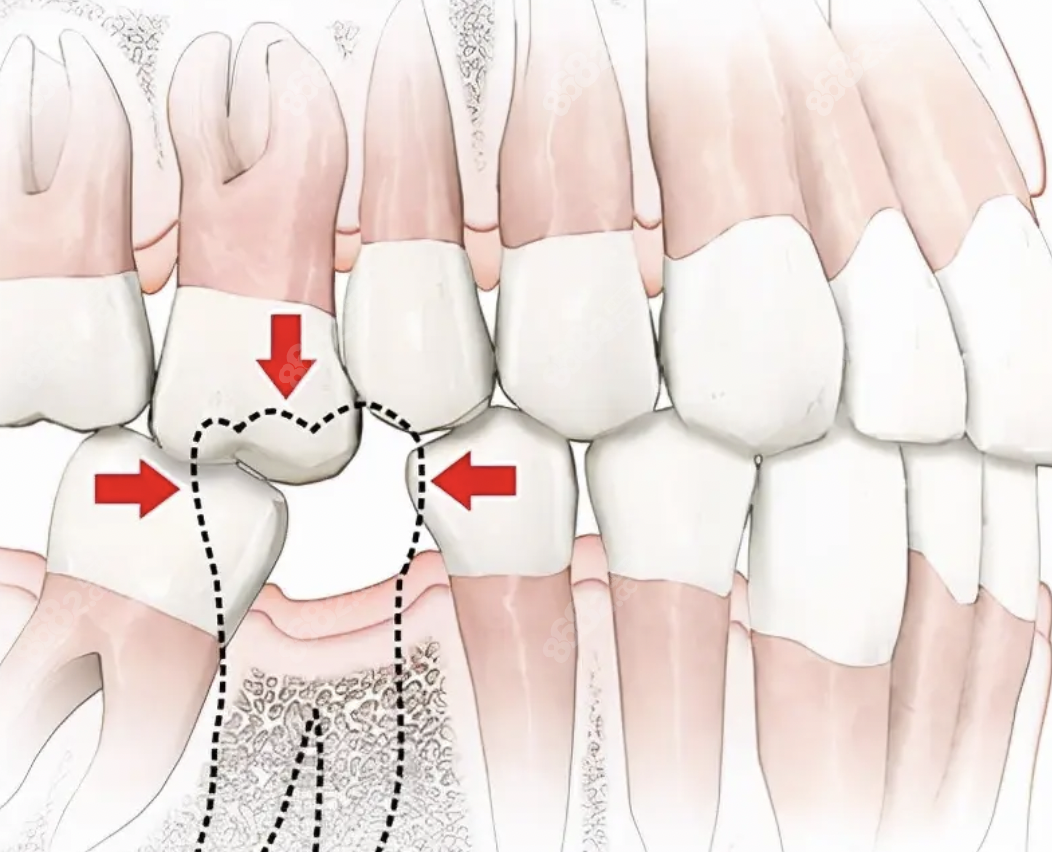 第二磨牙的结构图解图片