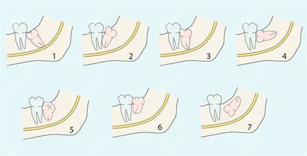 智齿的生长图