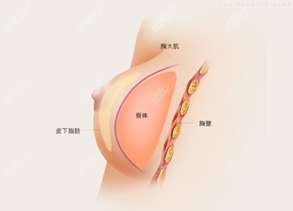 乳房再造假体移植