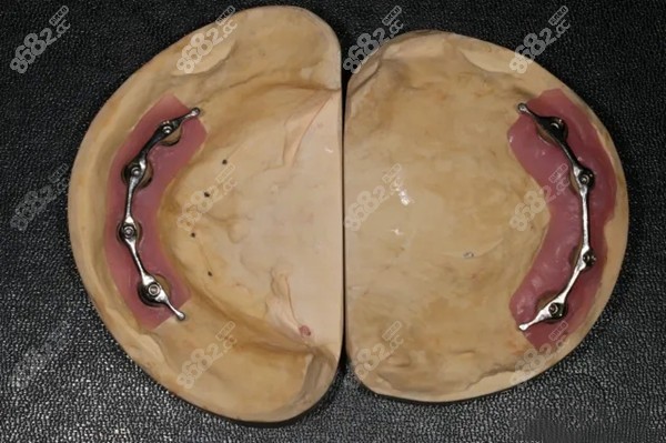 的有:杆卡式种植覆盖义齿,球帽式种植覆盖义齿,locator种植覆盖义齿