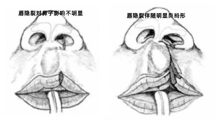 唇隐裂的2种类型图片