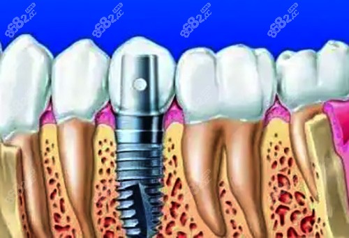 单颗种植牙的侧面剖析图