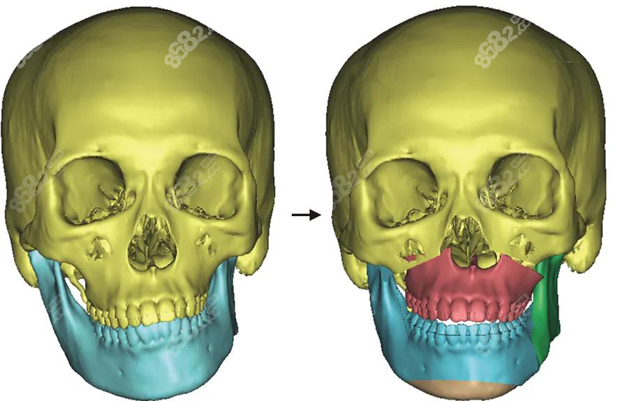 正颌手术前后对比图@8682网