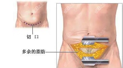 腹部拉皮术原理