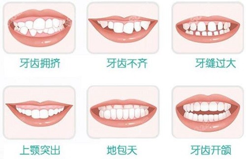牙齿矫正适应症