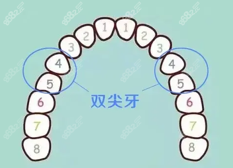 牙齿矫正前拔除的牙齿一般是双尖牙