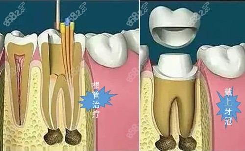 做根管治疗