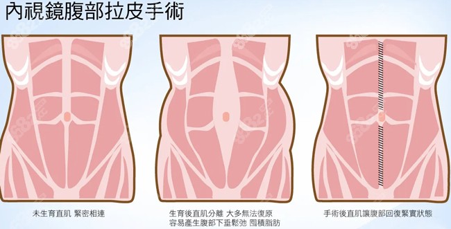 腹部拉皮手术原理图