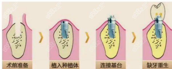 种植牙过程