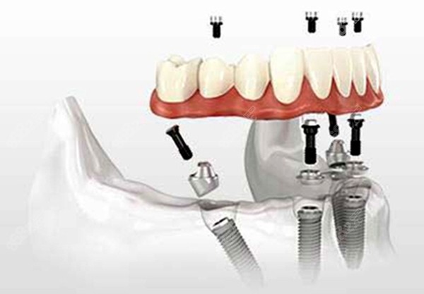 半口all on 4种植牙的图
