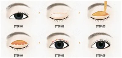 林靖医生做双眼皮手术的技术优势2