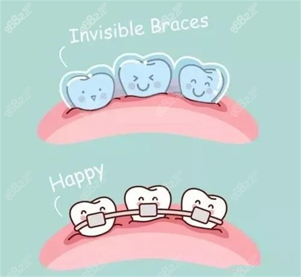 隐形矫正和金属矫正牙套图