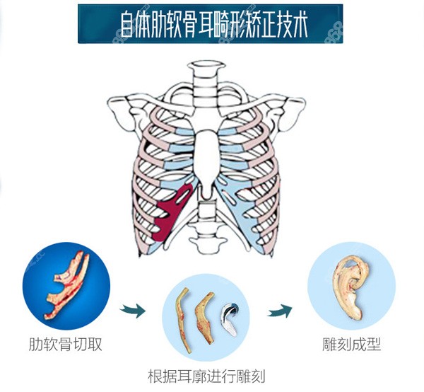 南京耳再造哪个医院好?