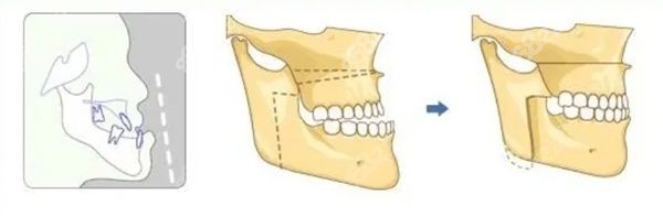 骨性地包天只做正畸不做正颌示例对比图片.jpg