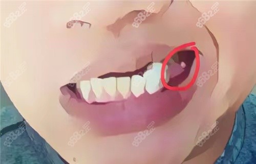 如果是牙龈瘤的话会自己消退吗?,牙齿保养