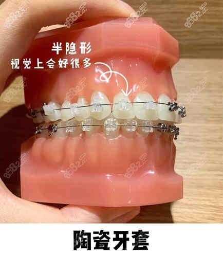 冰晶托槽和陶瓷托槽的区别是什么