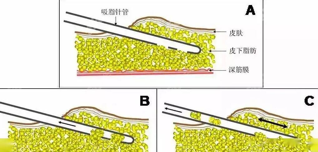 腰腹环吸