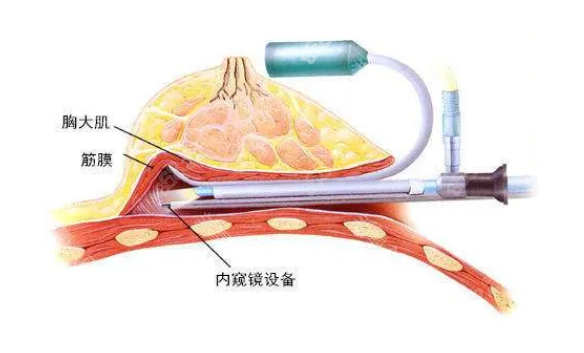 特贝茨隆胸的手术方法