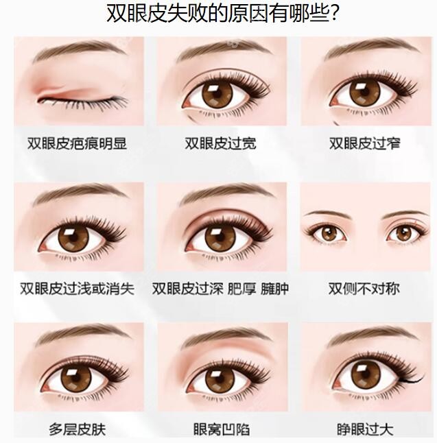 珠海韩妃医疗美容双眼皮修复类型