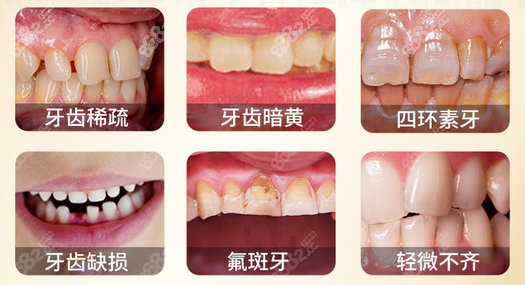 牙齿贴面适应症