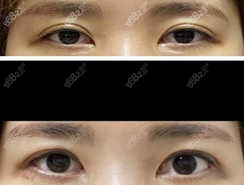 韩国爱护眼修复前后对比图