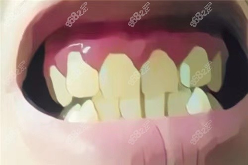 如果是牙龈瘤的话会自己消退吗