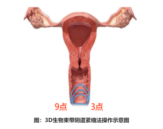 做3d生物束带紧缩术有什么后遗症