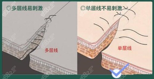 精细缝合双眼皮切口能避免产生多层褶皱