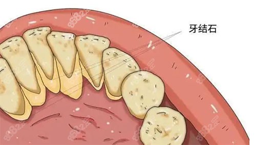 牙结石