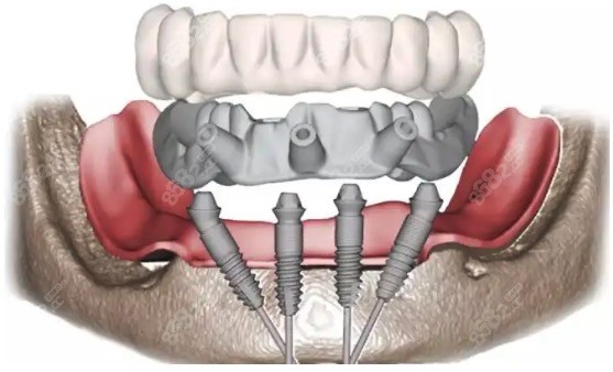 All-on-4种植牙修复半口牙