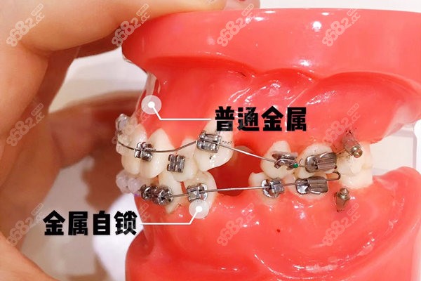 宝山区正畸收费标准