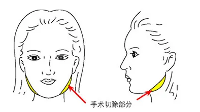 下颌角整形后遗症皮肤松弛吗