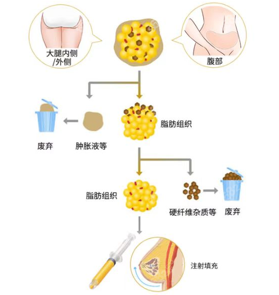 柳州做脂肪填充丰胸的过程图