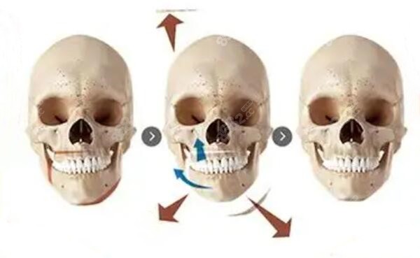 骨性偏颌中骨骼的样子