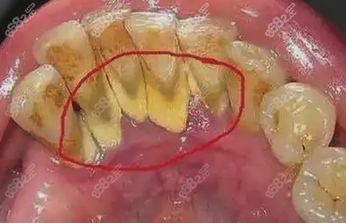 牙齿结石堆积过多