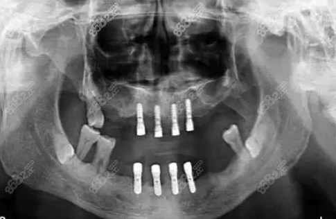 种植牙修复全口牙缺失