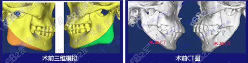 廣州廣大何晉泉下頜角修復(fù)手術(shù)圖示 廣州廣大何晉泉下頜角修復(fù)手術(shù)圖示