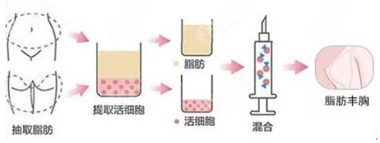 丰胸手术后几天能拆线？