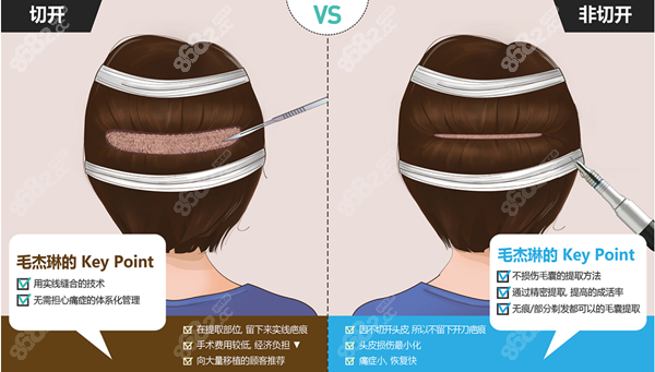 韩国毛杰琳植发技术优势