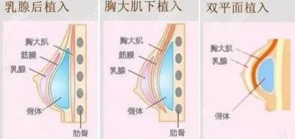 丰胸手术后几天能拆线？