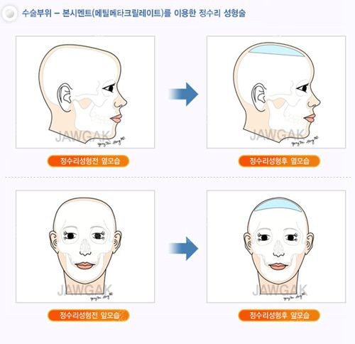 雕刻整形医院头部整形