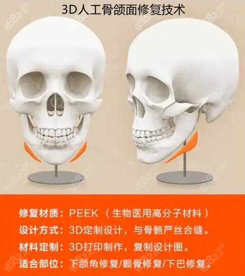 上海時(shí)光何晉龍peek人工骨修復(fù)下頜角缺失優(yōu)勢(shì) 上海時(shí)光何晉龍peek人工骨修復(fù)下頜角缺失優(yōu)勢(shì)