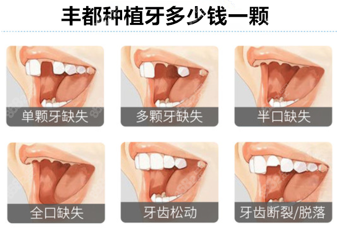 丰都种植牙多少钱一颗