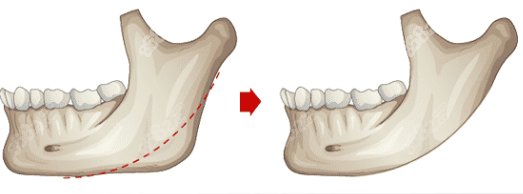 下颌角整形后遗症有哪些