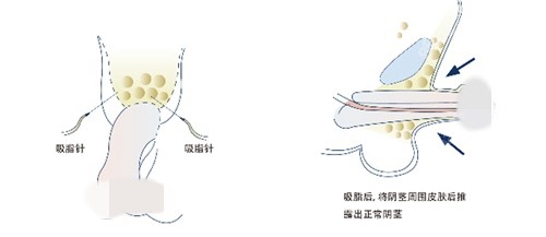 男性私密延长手术原理