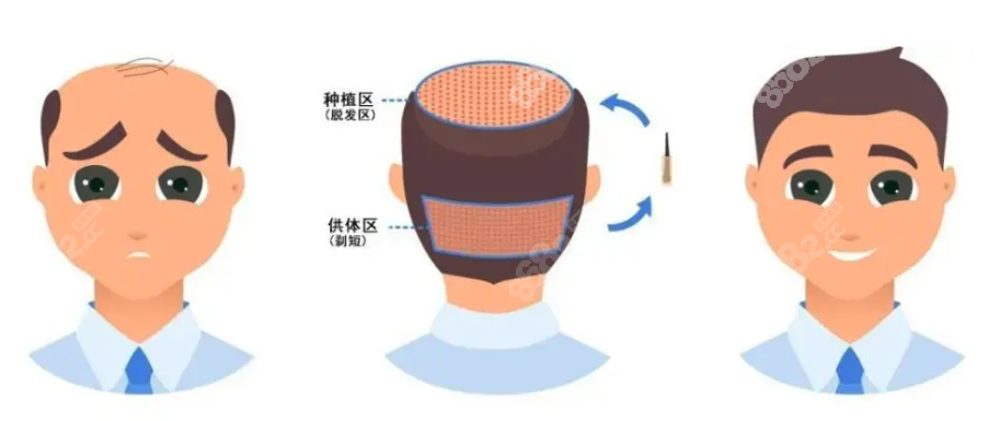 韩国发际线种植哪家医院好