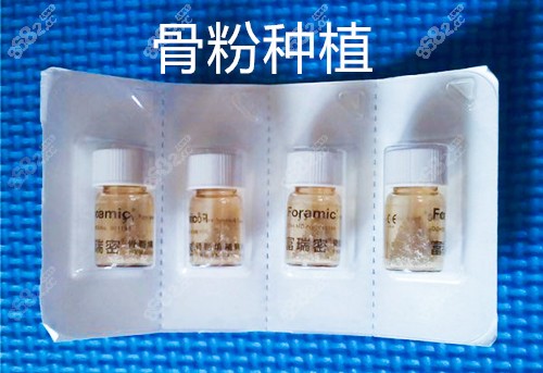 种一颗槽牙的费用多少钱