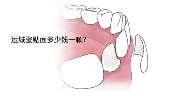 运城做瓷贴面多少钱一颗