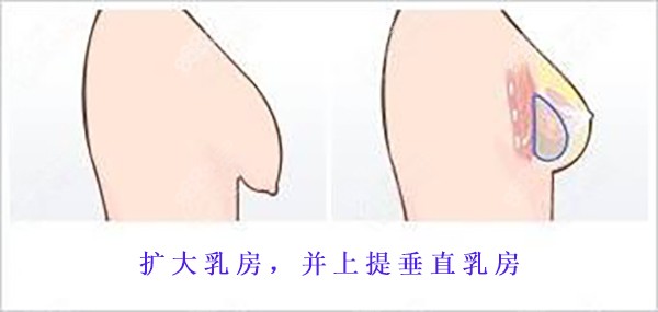 丰胸假体提升乳房